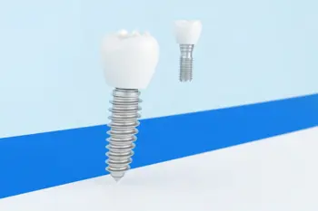 Soluzioni convenienti per impianti dentali dopo la perdita di un dente: analisi delle opzioni cliniche e dei fattori di costo