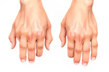 Early signs of rheumatoid arthritis in hands: Clinical patterns and evaluation