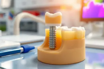 Prix véritable de l'implant dentaire pour les seniors : Analyse des tarifs réels et des remboursements en 2026