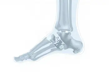 Heel spur heel pain: Surgeon-recommended recovery and clinical insights