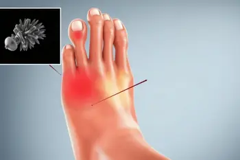 Warning signs of gout: A clinical guide to symptoms and escalation