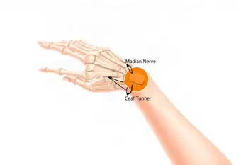 Warning signs of carpal tunnel syndrome: A clinical analysis of early detection and nerve health