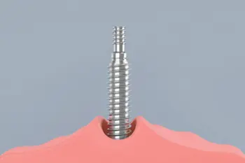 Dental implants available: single-tooth implants in 2026: A Clinical and Financial Analysis