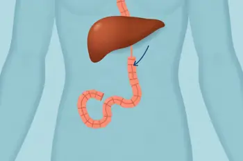 Recognizing early warning signs of bile duct cancer: A clinical evidence briefing