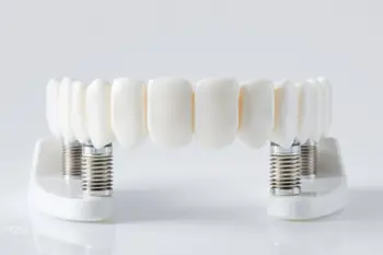 Options d'implants dentaires Full-arch pour adultes en 2026 : Analyse technique, protocoles cliniques et perspectives de marché