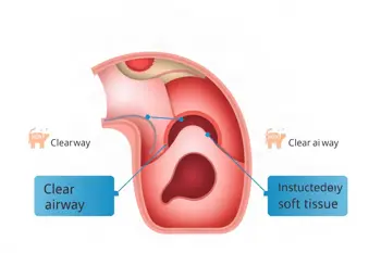 Warning signs of sleep apnea: A Clinical Analysis of Symptom Presentation and Health Risks