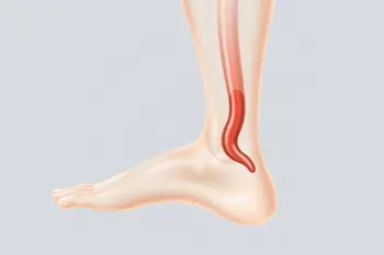 Warning signs of deep vein thrombosis: Clinical identification and medical emergency indicators