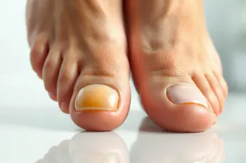 Top antifungal treatments for toenail fungus: Evidence, options, and clinical considerations