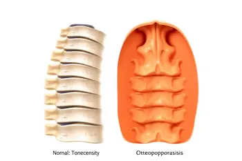 Osteoporose im Alter: Ursachen und Symptome von Rückenschmerzen erkennen: Eine klinische Analyse des schleichenden Knochenschwunds