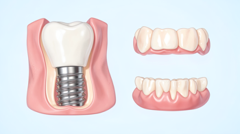 Tek bir diş kaybından sonra Türkiye'de diş implantı seçenekleri: Klinik değerlendirme ve süreç raporu
