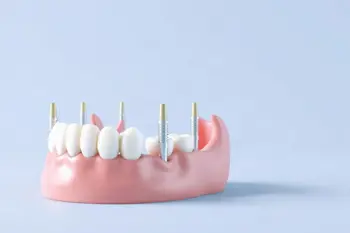 Affordable lower-jaw dental implants near me: A Guide to Clinical Options and Financial Considerations