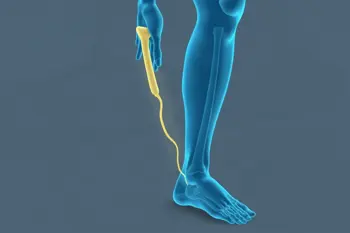 Understand sciatica treatment options: A Comprehensive Clinical Analysis for Patient Education