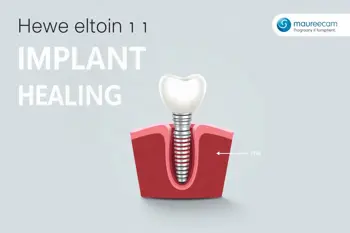 Home recovery for dental implants: A clinical analysis of postoperative care and healing timelines