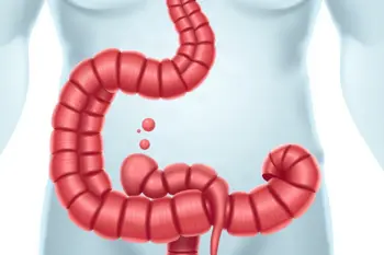 Early symptoms of Diverticulitis you should know: An analytical overview of clinical signs and diagnostic indicators