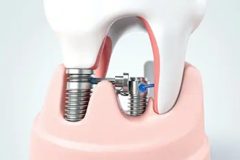 Dental Implant Solutions and Financial Outlays: A 2026 Consumer Research Guide