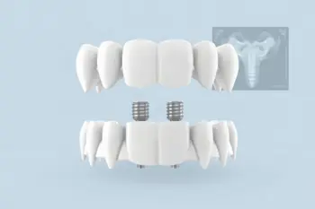 Impianti dentali All-on-4 convenienti nella tua zona: analisi dei costi, dei criteri clinici e delle alternative