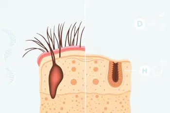 Hereditary Hair Loss: Genetics and Modern Solutions