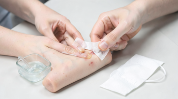Effective strategies for managing minor skin wounds at home: A clinical guide to safe first aid
