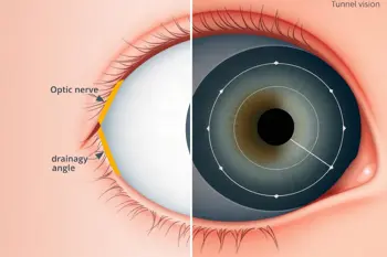 Warning signs of glaucoma: clinical patterns and when symptoms require evaluation
