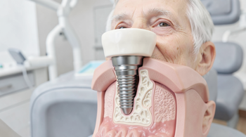 Implantes dentários sem parafusos para idosos: Guia Clínico e Analítico Completo
