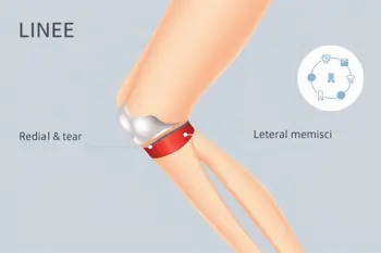Understand meniscus tear treatment options: An evidence-based clinical overview