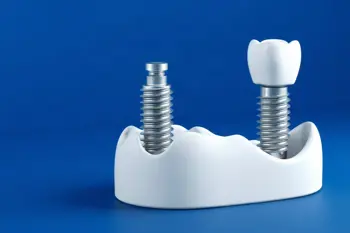 Single dental implant price list in the United States: An analytical breakdown of 2026 market data