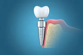 Dental implant procedures explained: a patient's guide to tooth restoration: clinical analysis of modern restorative protocols