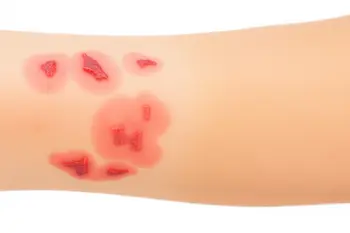 Recognizing Skin Eczema: Early Signs and Treatment Options - A Clinical Overview for Patients and Caregivers