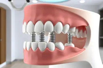Fiksni mostovi na implantatima: alternativa mobilnoj protezi - Analiza stomatoloških rješenja za trajni gubitak zuba