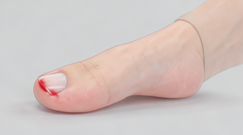 How to Treat an Ingrown Toenail Safely: Clinical Guidance for Home Care and Medical Evaluation
