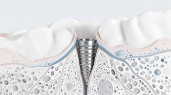 ¿Por qué elegir nuestros implantes dentales biocompatibles? Obtén tu guía gratuita: Análisis sobre materiales y salud bucal