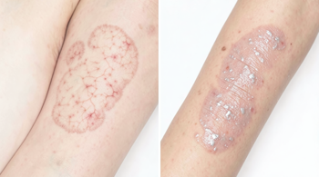 Early signs of eczema vs psoriasis flare up: A Clinical Comparison of Early Changes