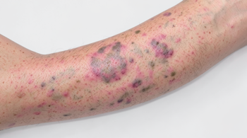 Early symptoms of Eczema you should know: A Clinical Guide to Recognizing Initial Signs