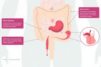 Warning signs of ulcerative colitis: A clinical guide to symptoms and red flags