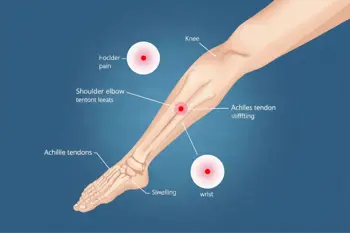 Signs you may have tendonitis: A Clinical Guide to Symptoms and Evaluation