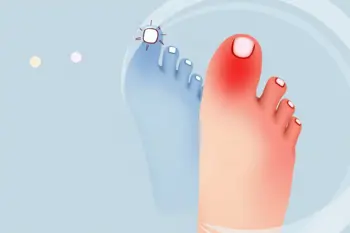 Symptoms of Raynaud's disease in toes: Clinical Analysis of Presentation and Vascular Response