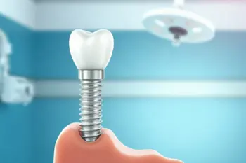 Affordable molar dental implants near me: A consumer research guide