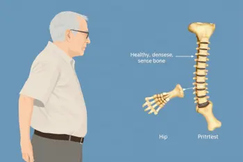 Warning signs of osteoporosis: clinical findings and when evaluation matters