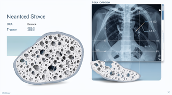Osteoporosis Early Detection: A Clinical Guide to Tools, Screening Thresholds, and Emerging AI Methods