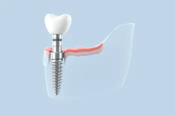 Impianti dentali senza viti costi anziani: analisi clinica e guida ai prezzi in Italia