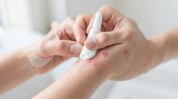 Ways to manage eczema flares at home: Clinical perspectives on dermatological self-care