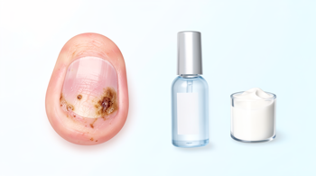 Best antifungal creams for nails: Clinical guidance on topical treatment options
