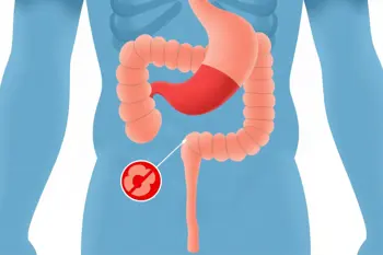 Warning signs of gastric ulcers: A clinical guide to symptoms and complications