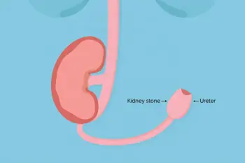 Early symptoms of Kidney Stones you should know: Clinical Warning Signs and Red Flags