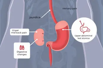 Warning signs of pancreatic cancer: Symptoms, patterns, and when medical evaluation matters