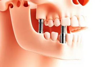 Get your full-arch dental implants in a single day: A clinical analysis of immediate-load restorative protocols