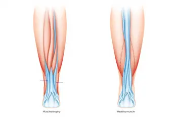 Perché le Gambe si Indeboliscono: Rimedi e Prevenzione - Analisi Clinica e Strategie Pratiche