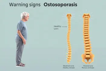 Warning signs of osteoporosis: Clinical findings and screening evidence