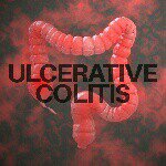 Ulcerative Colitis