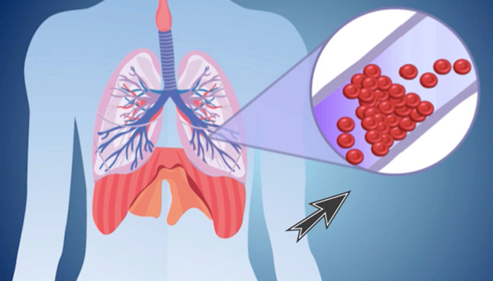Pulmonary embolism